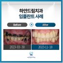 오송미소치과의원 | 오송치과에서 되찾는 자연스러운 미소, 치료 전 꼭 확인