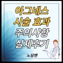 아그네스 | 모공 피지 개선을 위한 아그네스 시술, 효과와 후기 정리