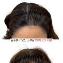 칠하다 | 인천칠하다두피문신 - 원형탈모 헤어라인 커버 후기