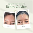 성산의원 | 바노바기의원 창원 피부과 이마필러 관자필러 솔직 후기!