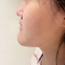 바라던치과의원 | 주걱턱 양악 수술 비용 3,000만 원 견적 받은 제 옆모습 변화