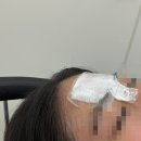 동성한의원 | 대구여드름한의원 이마 여드름 흉터치료 새살침 내돈내산 후기