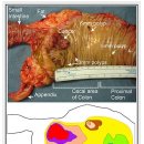 Carcinogenesis - 암발생의 조직학적 과정 이미지