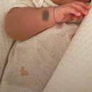 맑은윤피부과의원 | [d-1] 이소성 몽고반점 치료일기 / 여수맑은윤피부과 / 밀크커피반점과 이소성 몽고반점 차이