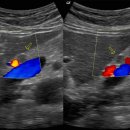 Duodenal diverticulum. 이미지