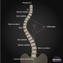 척추측만증 판단기준[척추옆굽음증(휘어진 척추의 각도)] 이미지