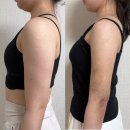 NR-30[달구벌대로]-하-24 | 대구반월당 팔 무한람스 당일 후기 붓기멍 통증