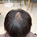 먼지나요디자인 | 3달 전 링거펌 자국 지우기, 볼륨매직과 모류교정으로 정수리 탈모 커버하기
