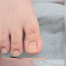 하이풋 | 병원에서 내성발톱 수술후, 발톱 변형과 갈라짐, 꾸준한 전문 케어가 답인 이유!
