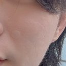 시전 | 내돈내산, 서브시전 + 쥬베룩 후기, 여드름 패인 흉터 변화는?, 여드름 치료, 피부 변화, 전후 사진