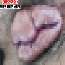 주식회사 신아주이트럭 | 수술하고도 재발한 치질 치핵! 3주만에 극복한 방법 (모르면 개손해)