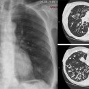 기관지 확장증[bronchiectasis] 이미지