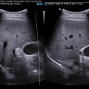 무담석 담낭염(acalculus cholecystitis) 이미지