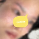 [피부관리] 내돈내산 | 포텐자+서브시전+쥬베룩 스킨 후기 1회차 :: 여드름 패인 흉터 치료