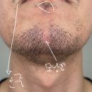 젠틀독 | 대구남자수염레이저제모 남성제모 젠틀맥스를 선택하는 후기