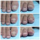 nailM뷰티샵 | 울산 내성발톱 교정 네일 엠 뷰티샵 : 4주 차 후기 [Nail M 뷰티]