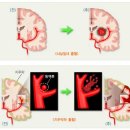 사망률 1위 뇌혈관 질환의 危嚴~! 이미지