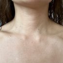 태성한방 | 강서/가양 화접몽한의원 거우침 편평사마귀 제거 리얼 후기(NO듀오덤, 바로 일상생활 가능)