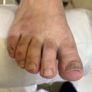 내원스크린골프 | 잠실 문제성발톱 케어 골프 즐기시는 50대 남성분의 발톱관리 후기