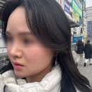 멍머니 | 압구정피부과 20대 울쎄라 내돈내산 한 달 차 솔직후기(전후 비교)