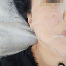 한국줄기세포 | 신사형통정형외과 줄기세포 피부재생 후기 (PRP), feat. 생얼장착