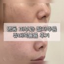 명동 피부과 | 쥬베룩볼륨 2cc 팔자주름 시술 후기