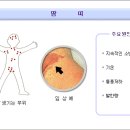 땀띠 이미지