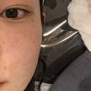 대전피부과 필로드부스트 : 리쥬란이랑 고민이라면? 시술과정 상세공개+솔직후기