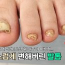 희귀병으로 약을 드신 후 급격히 나빠져버린 발톱! #oddlysatisfying #toenails 이미지