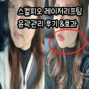 피오 | 대구 칠곡 피부과 스컬피오 레이저리프팅 윤곽관리 후기 효과