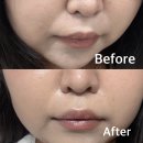 41190-01-07-240 | 건대피부과 팔자고민 올리디아 콜라겐주사 전후 후기 내돈내산(ft.이영애콜라겐주사)
