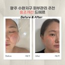 신창로 | 광주 드에르 수완지구 피부관리 홍조개선 비포애프터 후기