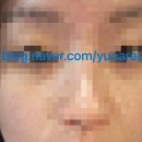 유로성형외과，피부과 | [찐 내돈내산] 홍조 개선에 좋은 브이빔 1회차 후기/오가나셀 청담점