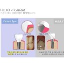 이든 치과기공소 네이버블로그