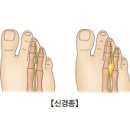 신경종 (Neuroma) 이미지