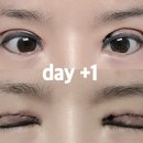 미방약국 | 쌍꺼풀 수술 후기 : 완전 절개 쌍수, 수술 당일~1주일 전후 사진