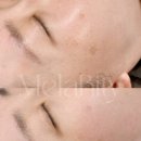 아카데미로272번길~ 지식기반로 | 일산 송스뷰티 아카데미 멜라니티 시술 후기