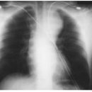 Aortic dissection - eMedicine 이미지