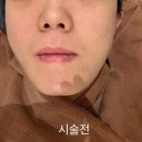 잠실새내역 | 잠실새내역 피부과 추천 온다리프팅후기