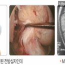 [십자인대파열] 십자인대파열 치료 방법에 대해 알아보자. 이미지