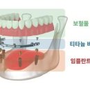 부분틀니로 인한 잇몸 부었을때 임플란트틀니 알아볼까요 이미지