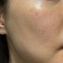 다음 | 남양주 별내피부과 피코토닝 가격 효과 주기 통증 다음날 일주일 후기