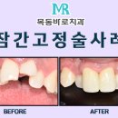 강선치과의원 | 잠간고정술 치료 후기