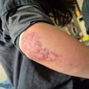 생생통삼겹 | 팔뚝 지방흡입 후기(3) - 지나치게 생생한 시술 후 일주일 회복기(혐짤주의)