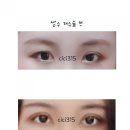 김호준피부과의원 | [창원마산]쌍수 재수술 후기