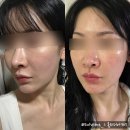 십사일동안 | 압구정피부과)) 올리디아 내돈내산 시술 후기, 콜라겐부스터로 자연스러운 볼륨과 탄력 한번에 잡구왔어요!