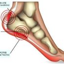 발바닥 뒤꿈치 통증 갑자기 걸을때 뒷꿈치 통증 원인 이미지