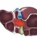 담도패쇄(Biliary atresia) 이미지