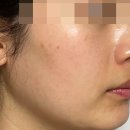 원레이져 | 마곡역 피부과 원데이 토닝, 얼굴 레이저 제모 상세 후기