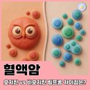 젊은약사들 | 혈액암 중 호지킨 vs 비호지킨 림프종, 뭐가 다를까? 약사가 쉽게 비교해 주는 초기증상, 원인, 치료